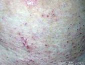 疥疮治疗方法,外用药物、口服药物与环境处理的综合策略”