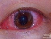 结膜炎的治疗方法,药物、食疗与日常护理